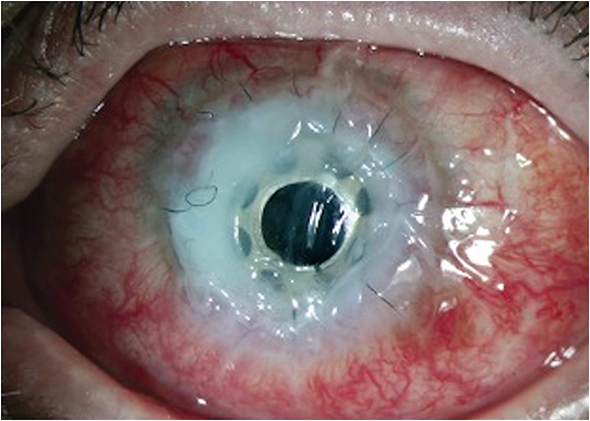 FIGURE 4: Corneal melting is an example of a possible related complication of KPro. Treatment: systemic anti-inflammatory drugs, escalating to a chimeric antibody.