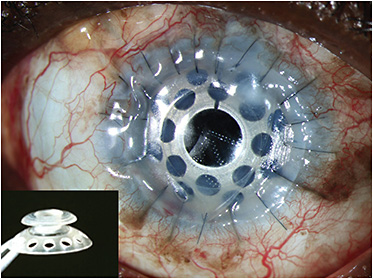 FIGURE 1: The back plate holes are shown to reduce corneal stromal melts.