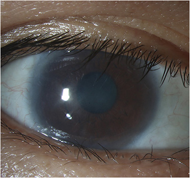 Corneal Physician | PentaVision