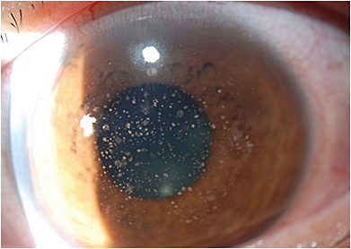 FIGURE 1. Presentation of microsporidia keratitis in a contact lens wearer previously treated with a topical steroid for contact lens-related keratitis. Symptoms and signs resolved with debridement and topical moxifloxacin. IMAGE COURTESY SUMITRA KHANDELWAL, MD