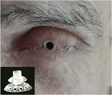 FIGURE 2: Implanting this KPro involves a complete tarsorrhaphy.