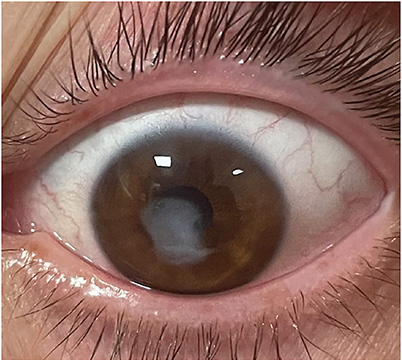 Note the large central scar after resolution of the pseudomonal corneal ulcer. IMAGE COURTESY TYLER C. GOFF, MD