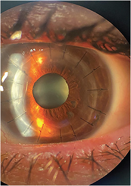 This photo shows a patient 3 months after penetrating keratoplasty. IMAGE COURTESY TYLER C. GOFF, MD