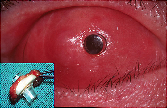 FIGURE 3: MOOKP is indicated for cases of bilateral blindness associated with significant conjunctival dryness and corneal diseases not suited for conventional PK.