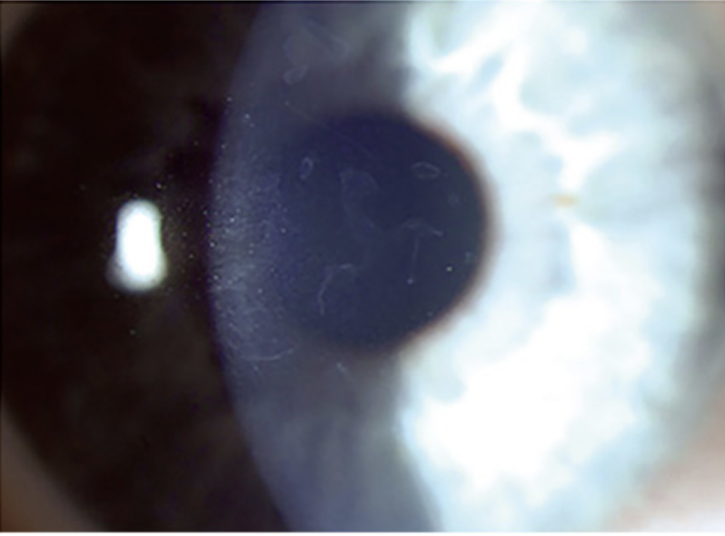 Corneal Epithelial Dystrophy