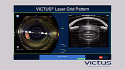 VICTUS® Laser Grid Pattern