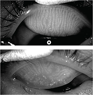 Reviewing In-Office Dry Eye Disease Treatments | Corneal Physician