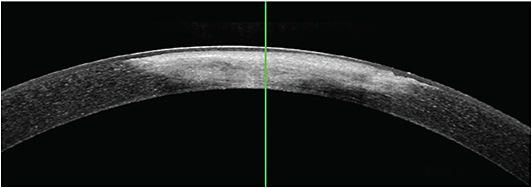 AS-OCT imaging shows the extent of corneal scarring. Hyperreflectivity extends to Descemet’s Membrane. IMAGE COURTESY TYLER C. GOFF, MD