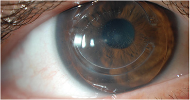 A RGP lens separates the cornea tissue from the cataract, facilitating diagnosis.